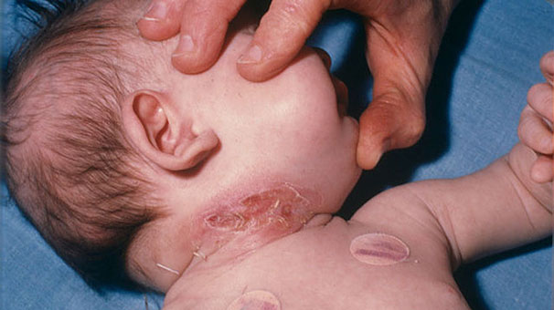 Difteri salgını Yemen'de 91 can aldı